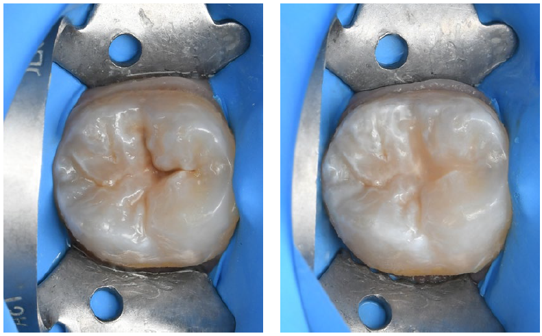 Fig. 11: Tooth before and after treatment using the stamp technique.